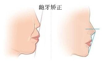 明星龅牙矫正对比,见证美丽蜕变之旅